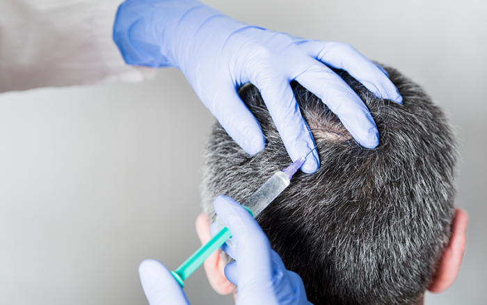 Does PRP Therapy Reverse Hair Loss? . Dermatology Partners Does PRP Therapy Reverse Hair Loss? . Dermatology Partners