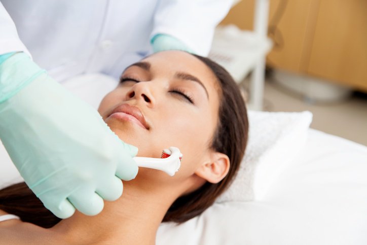 Woman receiving microneedling - What Is Microneedling?