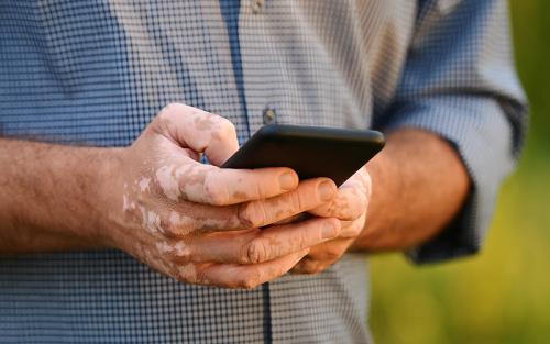 A person with vitiligo on their hands using a smartphone while wearing a blue checkered shirt outdoors.