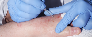 A dermatologist in blue gloves performing a skin procedure on a patient's arm with a specialized tool.