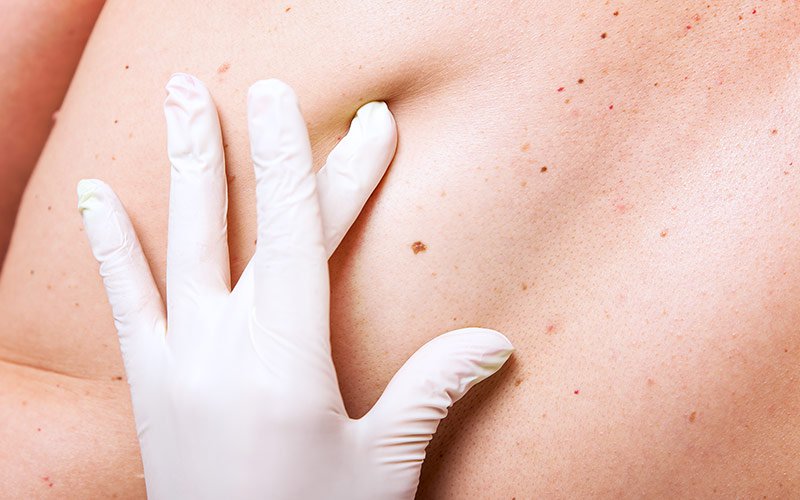 Patient Receiving Full-Body Skin Exam