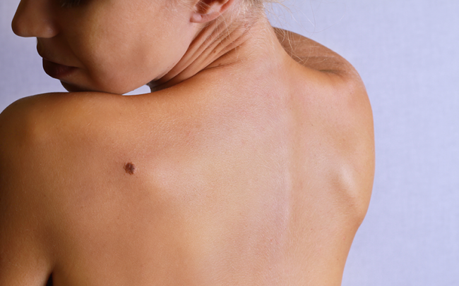 Nodular melanoma sales