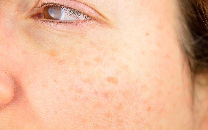 When Should You Be Worried About Sunspots on Your Face?