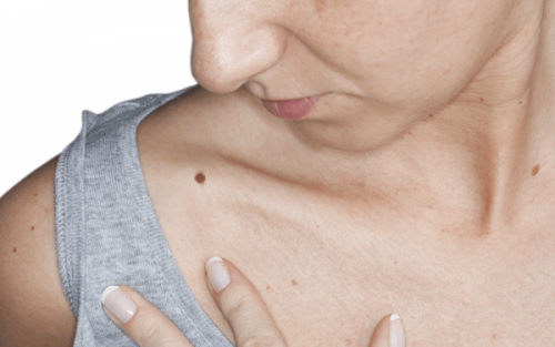 Woman Examining Mole - Flat Mole Removal