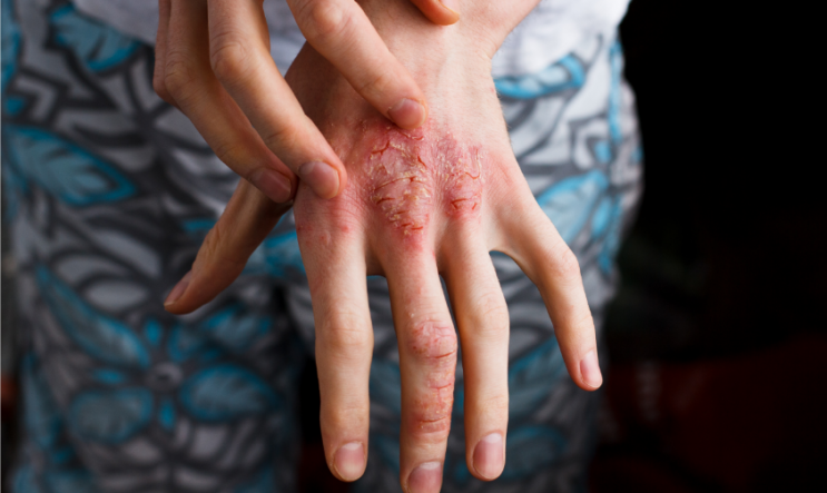 How does Psoriasis affect the body?
