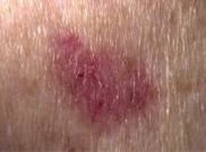 How to Spot Skin Cancer: What Does Skin Cancer Look Like and Is It Itchy?