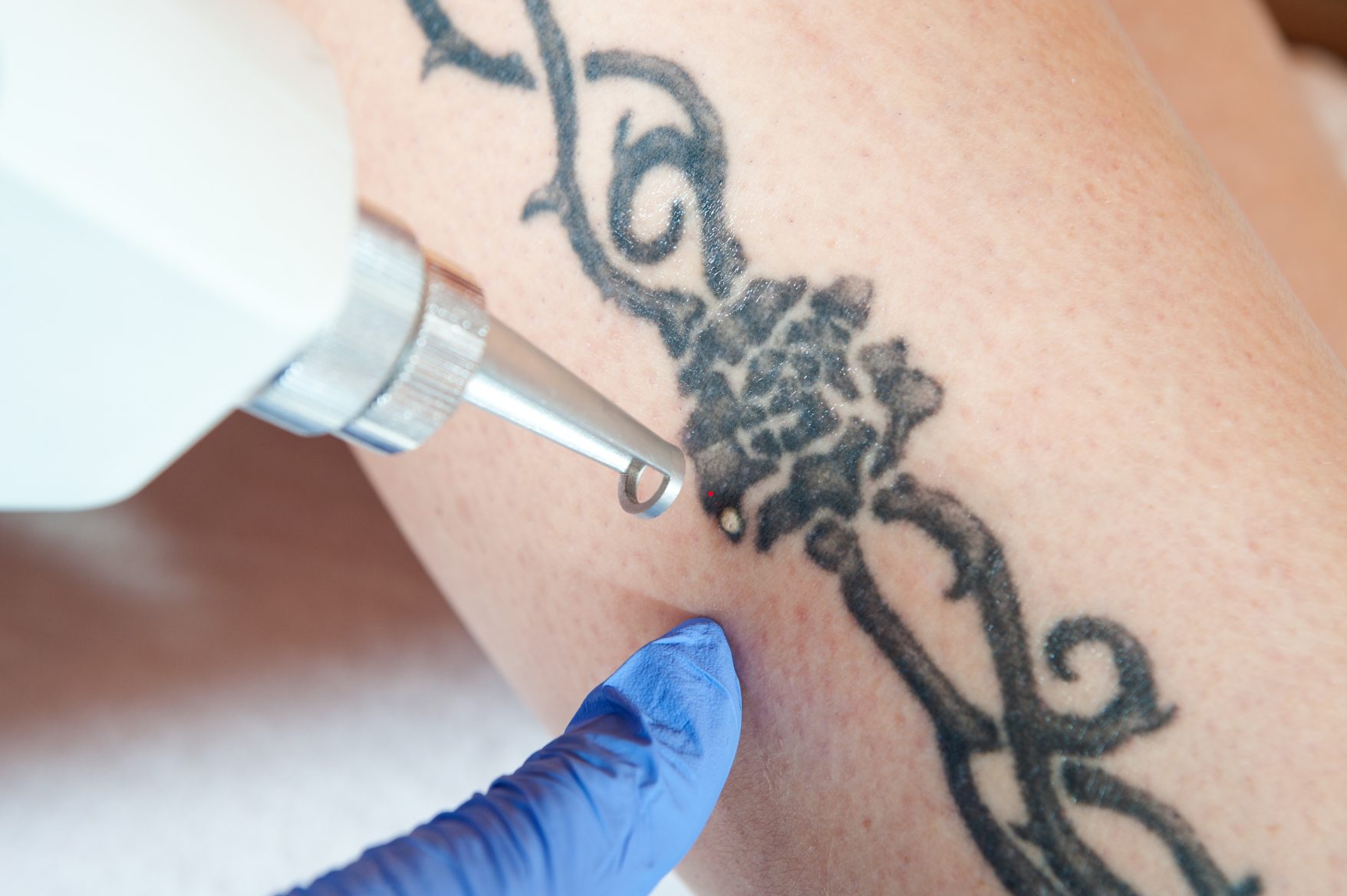 Tattoo removal being performed with a laser