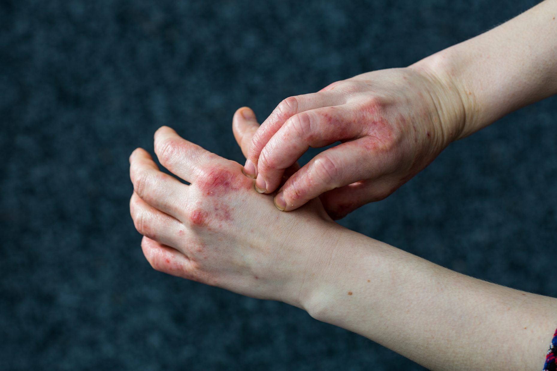 Contact dermatitis covered hands