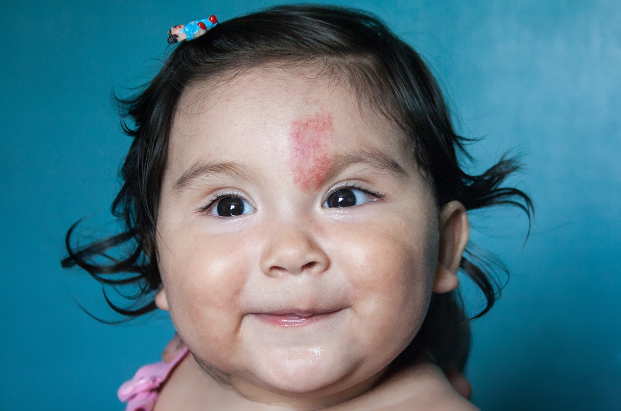 infant with birthmarks