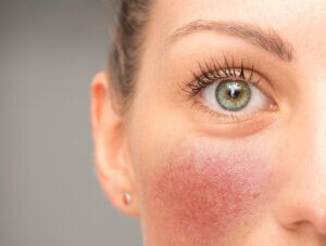Woman looking in the mirror at rosacea