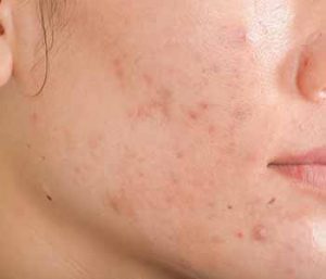 Dr. Neeraja Mattay at Dermatology Associates of Northern Virginia, Inc explains whether acne treatments in Centreville, VA are safe