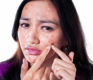Dr. Neeraja Mattay at Dermatology Associates of Northern Virginia, Inc explains whether acne treatments in Centreville, VA are safe