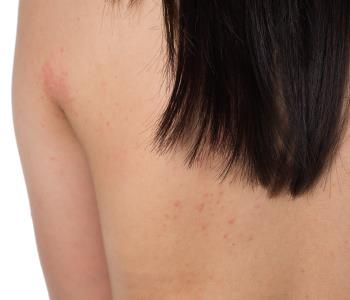 Effective treatment with UV light therapy for skin with eczema from dermatologist herndon, va