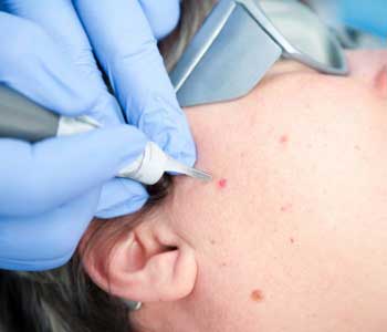 get rid of skin moles and growths in Centreville