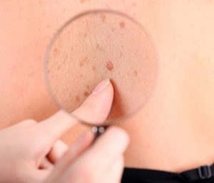Port Wine Stain Birthmark Treatment Chantilly VA
