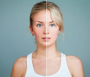 Rosacea Treatment Centreville VA