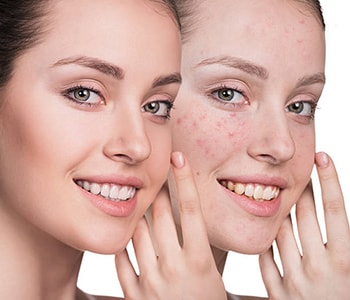 Skin Peels For Acne Chantilly Virginia