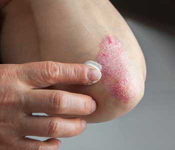 Eczema be cured with treatment
