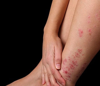 What Is Psoriasis Chantilly Virginia