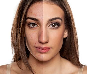 acne medications and therapies from centreville dermatologist
