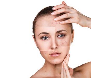 treatment for acne from Dermatologist in Sterling