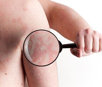 dermatologist in ashburn help treat and control eczema