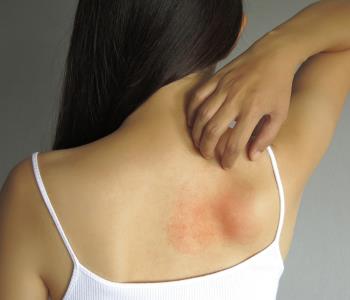 top-notch, effective eczema treatment from dermatologist in manassas, va