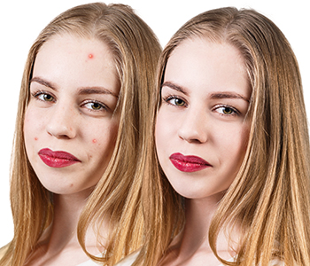 acne treatment ashburn