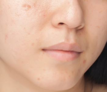 woman acne on womens face