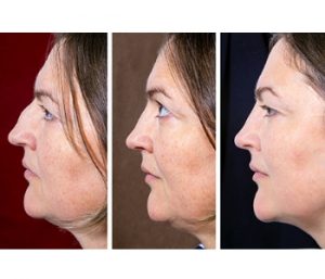 Kybella Double Chin Treatment | U.S. Dermatology Partners