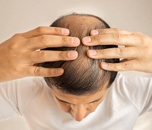 PRP Hair Treatment Centreville