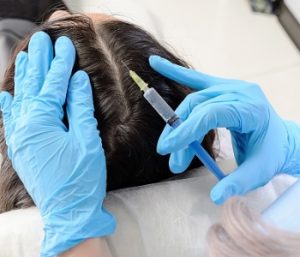 PRP Injection for Hair Loss