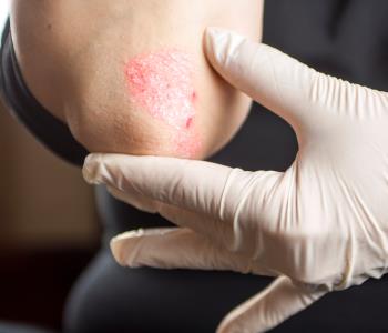 Effective psoriasis skin care treatment from dermatologist in manassas, va