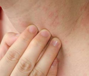 Diagnosing Psoriasis for patients, Dermatology Associates of Northern Virginia, Inc