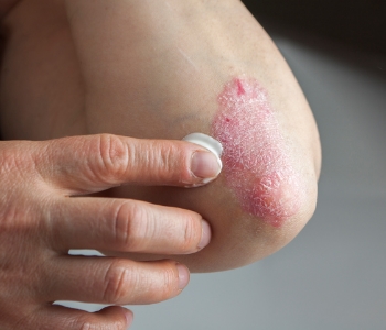psoriasis rash on elbow