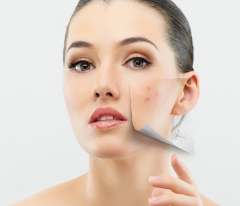 girl skin pealing way acne