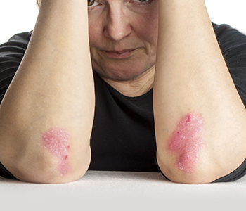 Ashburn area provides treatments for various types of psoriasis