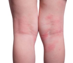 eczema on back of a girls leg