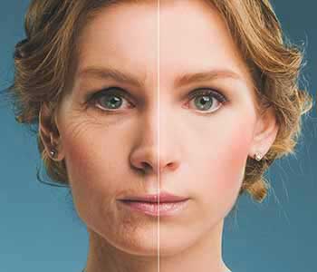How the Skin Ages and How Wrinkle Treatments Can Help