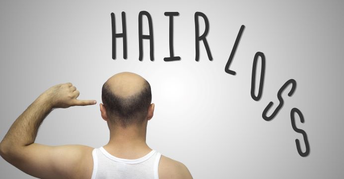 Man with hair loss pointing to balding head