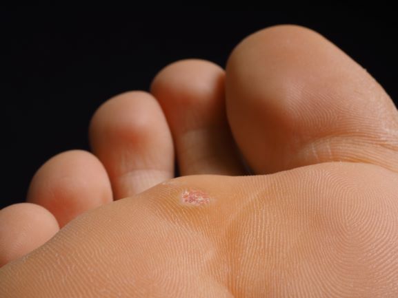 Foot with plantar warts