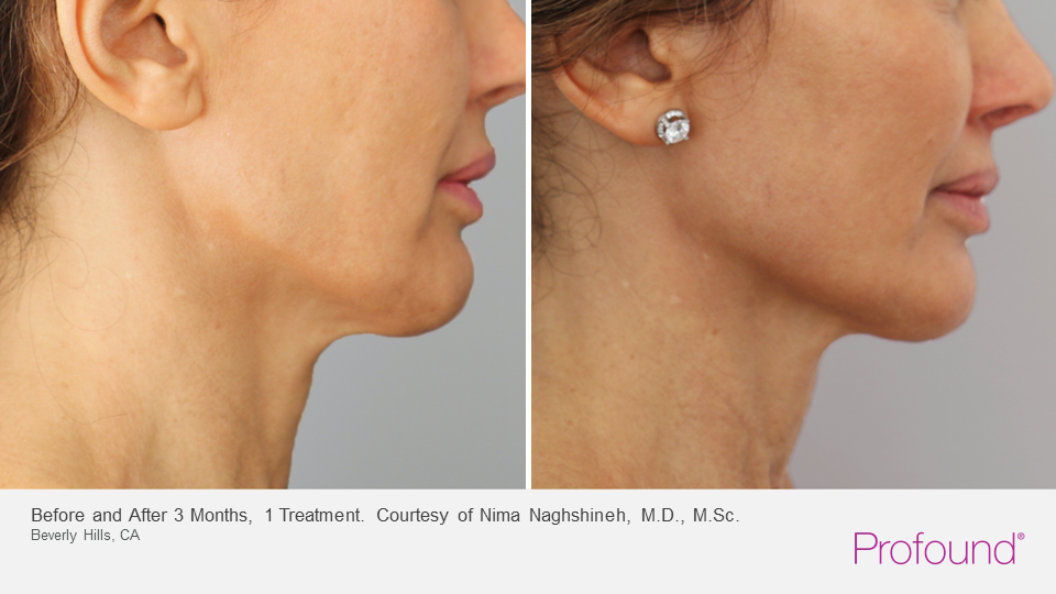 Patient 149342194  Profound RF Skin Tightening Before & After