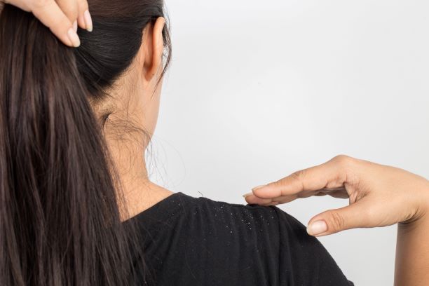 Dandruff vs Dry Scalp, which one is this woman suffering from