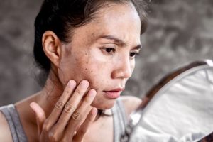 Woman looking at dark spots on face