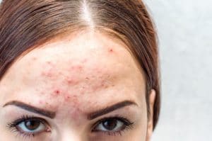 Woman with fungal acne on forehead