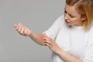 Woman with allergic reaction on arm