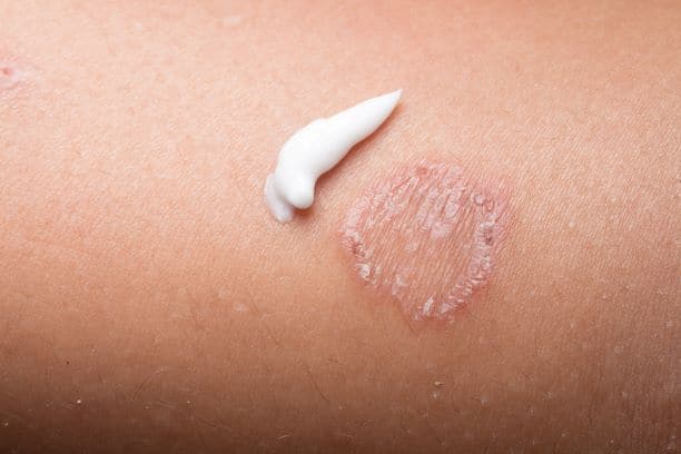 Ringworm Treatment on skin