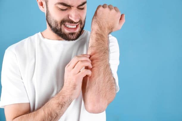 Man scratching eczema itch