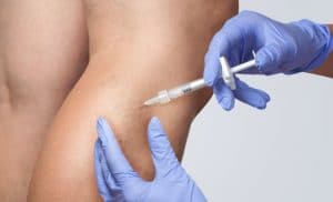 Sclerotherapy performed on leg vein