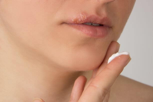 Woman with cold sores on lip